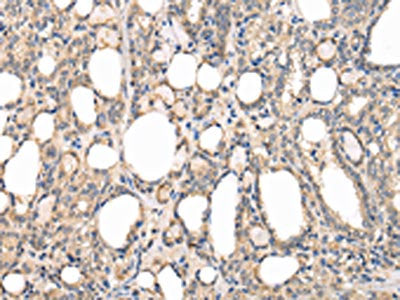 The image on the left is immunohistochemistry of paraffin-embedded Human thyroid cancer tissue using PPP5C Antibody(PPP5C Antibody) at dilution 1/20, on the right is treated with fusion protein. (Original magnification: ×200)Rabbit anti-Human PPP5C Polyclonal Antibody