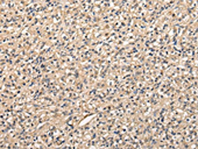 The image on the left is immunohistochemistry of paraffin-embedded Human prostate cancer tissue using the antibody Antibody) at dilution 1/20, on the right is treated with fusion protein. (Original magnification: ×200)Rabbit anti-Human PPP5C Polyclonal Antibody