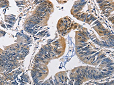 The image on the left is immunohistochemistry of paraffin-embedded Human colon cancer tissue using PGK1 Antibody(PGK1 Antibody) at dilution 1/50, on the right is treated with fusion protein. (Original magnification: ×200)Rabbit anti-Human PGK1 Polyclonal Antibody