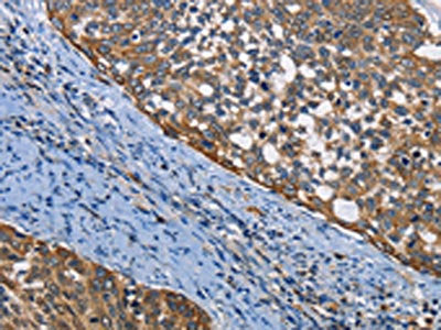 The image on the left is immunohistochemistry of paraffin-embedded Human cervical cancer tissue using the antibody Antibody) at dilution 1/50, on the right is treated with fusion protein. (Original magnification: ×200)Rabbit anti-Human PGK1 Polyclonal Antibody