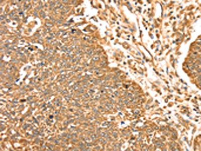 The image on the left is immunohistochemistry of paraffin-embedded Human lung cancer tissue using MAPK7 Antibody(MAPK7 Antibody) at dilution 1/35, on the right is treated with fusion protein. (Original magnification: ×200)