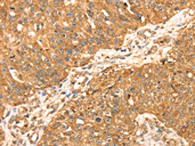 The image on the left is immunohistochemistry of paraffin-embedded Human breast cancer tissue using the antibody Antibody) at dilution 1/35, on the right is treated with fusion protein. (Original magnification: ×200)