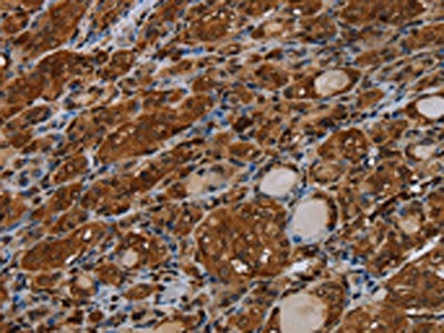 The image on the left is immunohistochemistry of paraffin-embedded Human thyroid cancer tissue using the antibody Antibody) at dilution 1/40, on the right is treated with synthetic peptide. (Original magnification: ×200)Rabbit anti-Human MYBBP1A Polyclonal Antibody