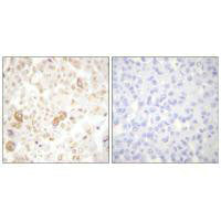 Immunohistochemical analysis of paraffin-embedded human breast carcinoma tissue using Cyclin F antibody.