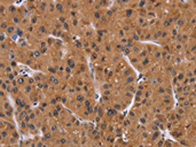 The image on the left is immunohistochemistry of paraffin-embedded Human liver cancer tissue using PPIB Antibody(PPIB Antibody) at dilution 1/40, on the right is treated with fusion protein. (Original magnification: ×200)Rabbit anti-Human PPIB Polyclonal Antibody