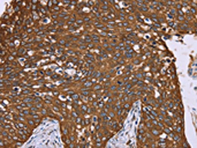 The image on the left is immunohistochemistry of paraffin-embedded Human cervical cancer tissue using the antibody Antibody) at dilution 1/40, on the right is treated with fusion protein. (Original magnification: ×200)Rabbit anti-Human PPIB Polyclonal Antibody