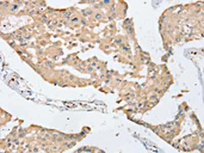 The image on the left is immunohistochemistry of paraffin-embedded Human prostate cancer tissue using SERINC3 Antibody(SERINC3 Antibody) at dilution 1/20, on the right is treated with synthetic peptide. (Original magnification: ×200)
