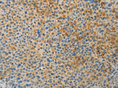 The image on the left is immunohistochemistry of paraffin-embedded Human liver cancer tissue using the antibody Antibody) at dilution 1/30, on the right is treated with fusion protein. (Original magnification: ×200)