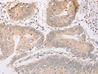 The image on the left is immunohistochemistry of paraffin-embedded Human colon cancer tissue using MARK1 Antibody(MARK1 Antibody) at dilution 1/30, on the right is treated with fusion protein. (Original magnification: ×200)