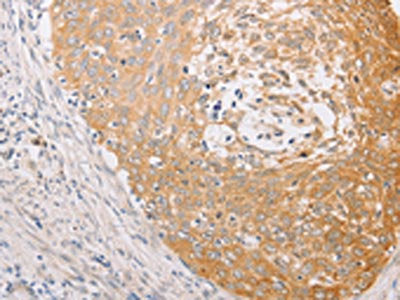 The image on the left is immunohistochemistry of paraffin-embedded Human cervical cancer tissue using the antibody Antibody) at dilution 1/30, on the right is treated with fusion protein. (Original magnification: ×200)