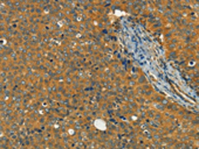 The image on the left is immunohistochemistry of paraffin-embedded Human cervical cancer tissue using the antibody Antibody) at dilution 1/40, on the right is treated with fusion protein. (Original magnification: ×200)