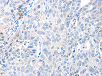 The image on the left is immunohistochemistry of paraffin-embedded Human ovarian cancer tissue using MAGEB4 Antibody(MAGEB4 Antibody) at dilution 1/40, on the right is treated with fusion protein. (Original magnification: ×200)