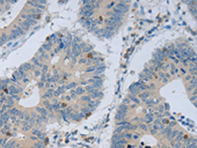 The image on the left is immunohistochemistry of paraffin-embedded Human colon cancer tissue using the antibody Antibody) at dilution 1/40, on the right is treated with fusion protein. (Original magnification: ×200)