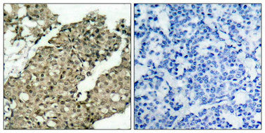 Immunohistochemical analysis of paraffin-embedded human breast carcinoma tissue using G3BP-1(Phospho-Ser232) Antibody(left) or the same antibody preincubated with blocking peptide(right).Rabbit anti-Human G3BP1 Polyclonal Antibody