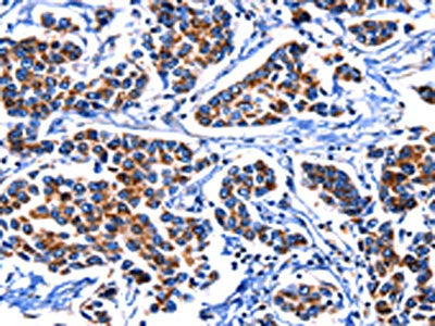 The image on the left is immunohistochemistry of paraffin-embedded Human breast cancer tissue using IGF2BP2 Antibody(IGF2BP2 Antibody) at dilution 1/15, on the right is treated with fusion protein. (Original magnification: ×200)Rabbit anti-Human IGF2BP2 Polyclonal Antibody