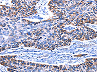 The image on the left is immunohistochemistry of paraffin-embedded Human esophagus cancer tissue using the antibody Antibody) at dilution 1/15, on the right is treated with fusion protein. (Original magnification: ×200)Rabbit anti-Human IGF2BP2 Polyclonal Antibody