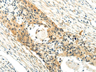 The image on the left is immunohistochemistry of paraffin-embedded Human esophagus cancer tissue using XK Antibody(XK  Antibody) at dilution 1/20, on the right is treated with synthetic peptide. (Original magnification: ×200)