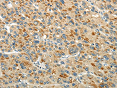The image on the left is immunohistochemistry of paraffin-embedded Human liver cancer tissue using the antibody  Antibody) at dilution 1/20, on the right is treated with synthetic peptide. (Original magnification: ×200)