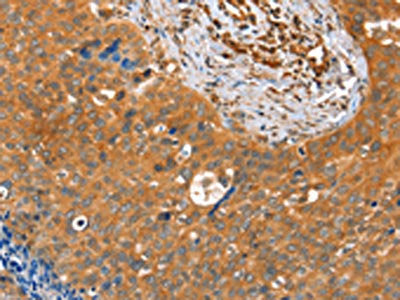 The image on the left is immunohistochemistry of paraffin-embedded Human cervical cancer tissue using the antibody Antibody) at dilution 1/25, on the right is treated with fusion protein. (Original magnification: ×200)