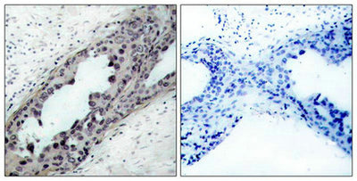 Immunohistochemical analysis of paraffin-embedded human breast carcinoma tissue, using PTEN(Phospho-Ser380/Thr382/Thr383) Antibody(left) or the same antibody preincubated with blocking peptide(right).Rabbit anti-Human PTEN Polyclonal Antibody
