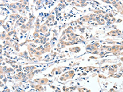 The image on the left is immunohistochemistry of paraffin-embedded Human breast cancer tissue using ADAM10 Antibody(ADAM10 Antibody) at dilution 1/30, on the right is treated with fusion protein. (Original magnification: ×200)
