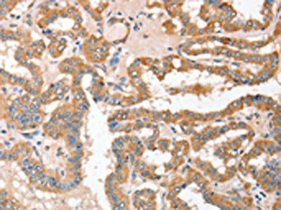The image on the left is immunohistochemistry of paraffin-embedded Human thyroid cancer tissue using the antibody Antibody) at dilution 1/30, on the right is treated with fusion protein. (Original magnification: ×200)