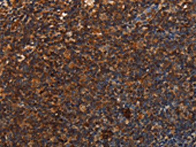The image is immunohistochemistry of paraffin-embedded Human tonsil tissue using UPK3B Antibody(UPK3B Antibody) at dilution 1/25. (Original magnification: ×200)Rabbit anti-Human UPK3B Polyclonal Antibody
