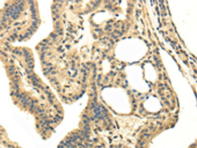 The image on the left is immunohistochemistry of paraffin-embedded Human thyroid cancer tissue using MED16 Antibody(MED16 Antibody) at dilution 1/20, on the right is treated with fusion protein. (Original magnification: ×200)