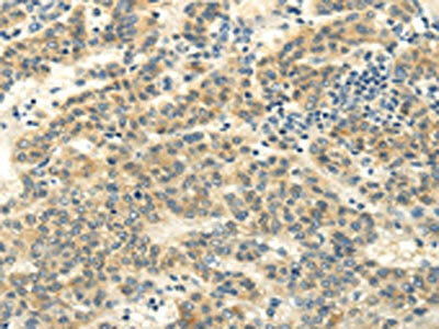 The image on the left is immunohistochemistry of paraffin-embedded Human liver cancer tissue using the antibody Antibody) at dilution 1/20, on the right is treated with fusion protein. (Original magnification: ×200)