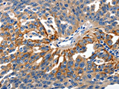 The image on the left is immunohistochemistry of paraffin-embedded Human ovarian cancer tissue using CLDN1 Antibody(CLDN1 Antibody) at dilution 1/150, on the right is treated with synthetic peptide. (Original magnification: ×200)Rabbit anti-Human CLDN1 Polyclonal Antibody