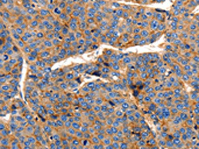 The image on the left is immunohistochemistry of paraffin-embedded Human liver cancer tissue using the antibody Antibody) at dilution 1/150, on the right is treated with synthetic peptide. (Original magnification: ×200)Rabbit anti-Human CLDN1 Polyclonal Antibody