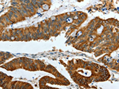 The image on the left is immunohistochemistry of paraffin-embedded Human colon cancer tissue using KRT19 Antibody(KRT19 Antibody) at dilution 1/15, on the right is treated with fusion protein. (Original magnification: ×200)
