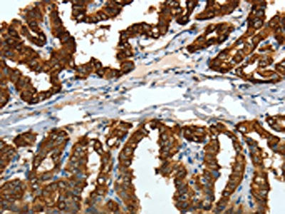 The image on the left is immunohistochemistry of paraffin-embedded Human thyroid cancer tissue using the antibody Antibody) at dilution 1/15, on the right is treated with fusion protein. (Original magnification: ×200)