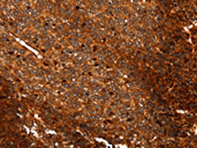 The image on the left is immunohistochemistry of paraffin-embedded Human ovarian cancer tissue using ALDOA Antibody(ALDOA Antibody) at dilution 1/25, on the right is treated with fusion protein. (Original magnification: ×200)Rabbit anti-Human ALDOA Polyclonal Antibody