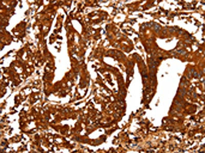 The image on the left is immunohistochemistry of paraffin-embedded Human gastic cancer tissue using the antibody Antibody) at dilution 1/25, on the right is treated with fusion protein. (Original magnification: ×200)Rabbit anti-Human ALDOA Polyclonal Antibody