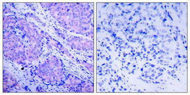 Immunohistochemical analysis of paraffin-embedded human breast carcinoma tissue using PDK1(Phospho-Ser241) Antibody(left) or the same antibody preincubated with blocking peptide(right).Rabbit anti-Human PDPK1 Polyclonal Antibody