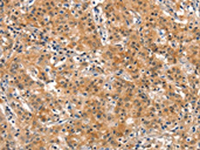 The image on the left is immunohistochemistry of paraffin-embedded Human gastric cancer tissue using DNM2 Antibody(DNM2 Antibody) at dilution 1/40, on the right is treated with synthetic peptide. (Original magnification: ×200)Rabbit anti-Human DNM2 Polyclonal Antibody