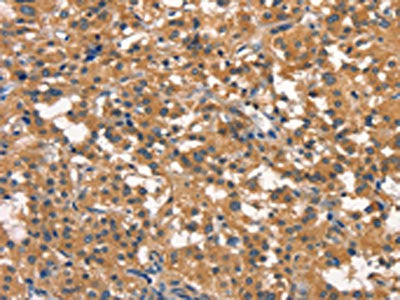 The image on the left is immunohistochemistry of paraffin-embedded Human thyroid cancer tissue using the antibody Antibody) at dilution 1/40, on the right is treated with synthetic peptide. (Original magnification: ×200)Rabbit anti-Human DNM2 Polyclonal Antibody