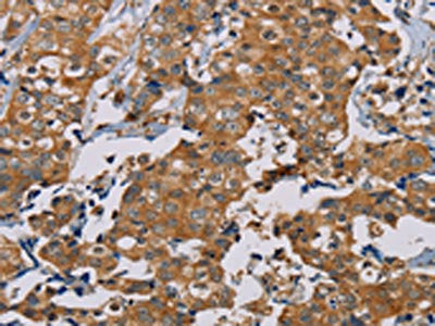 The image is immunohistochemistry of paraffin-embedded Human thyroid cancer tissue using TAB3 Antibody(TAB3 Antibody) at dilution 1/35. (Original magnification: ×200)Rabbit anti-Human TAB3 Polyclonal Antibody