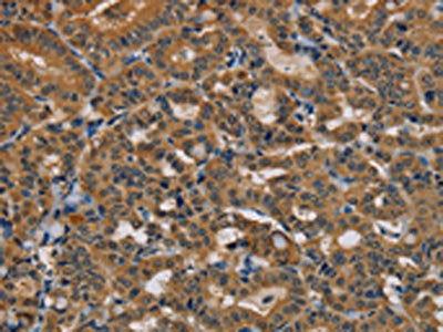 The image is immunohistochemistry of paraffin-embedded Human thyroid cancer tissue using the antibody Antibody) at dilution 1/35. (Original magnification: ×200)Rabbit anti-Human TAB3 Polyclonal Antibody