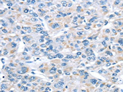 The image on the left is immunohistochemistry of paraffin-embedded Human liver cancer tissue using ITPA Antibody(ITPA Antibody) at dilution 1/30, on the right is treated with fusion protein. (Original magnification: ×200)