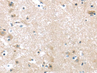 The image on the left is immunohistochemistry of paraffin-embedded Human brain tissue using the antibody Antibody) at dilution 1/30, on the right is treated with fusion protein. (Original magnification: ×200)