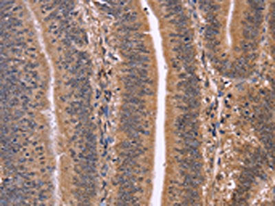 The image on the left is immunohistochemistry of paraffin-embedded Human colon cancer tissue using the antibody Antibody) at dilution 1/50, on the right is treated with fusion protein. (Original magnification: ×200)Rabbit anti-Human CLUAP1 Polyclonal Antibody