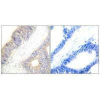 Immunohistochemistry analysis of paraffin-embedded human colon carcinoma tissue using Stefin A antibody.Rabbit anti-Human CSTA Polyclonal Antibody