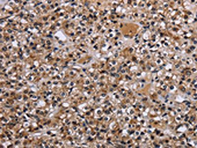 The image on the left is immunohistochemistry of paraffin-embedded Human prostate cancer tissue using REL Antibody(REL Antibody) at dilution 1/30, on the right is treated with fusion protein. (Original magnification: ×200)Rabbit anti-Human REL Polyclonal Antibody