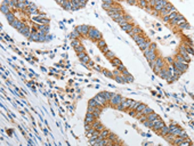 The image on the left is immunohistochemistry of paraffin-embedded Human colon cancer tissue using PRDX1 Antibody(PRDX1 Antibody) at dilution 1/20, on the right is treated with synthetic peptide. (Original magnification: ×200)Rabbit anti-Human PRDX1 Polyclonal Antibody