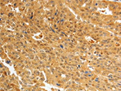 The image on the left is immunohistochemistry of paraffin-embedded Human ovarian cancer tissue using AKR1A1 Antibody(AKR1A1 Antibody) at dilution 1/25, on the right is treated with synthetic peptide. (Original magnification: ×200)Rabbit anti-Human AKR1A1 Polyclonal Antibody