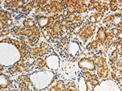 The image on the left is immunohistochemistry of paraffin-embedded Human thyroid cancer tissue using the antibody Antibody) at dilution 1/25, on the right is treated with synthetic peptide. (Original magnification: ×200)Rabbit anti-Human AKR1A1 Polyclonal Antibody