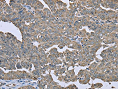 The image on the left is immunohistochemistry of paraffin-embedded Human ovarian cancer tissue using ESR2 Antibody(ESR2 Antibody) at dilution 1/20, on the right is treated with fusion protein. (Original magnification: ×200)Rabbit anti-Human ESR2 Polyclonal Antibody