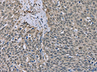 The image on the left is immunohistochemistry of paraffin-embedded Human cervical cancer tissue using the antibody Antibody) at dilution 1/20, on the right is treated with fusion protein. (Original magnification: ×200)Rabbit anti-Human ESR2 Polyclonal Antibody